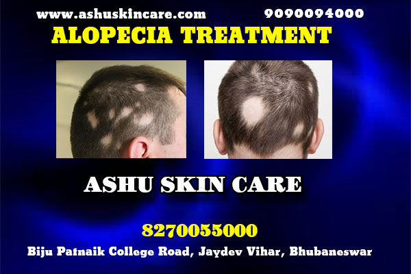 best alopecia treatment clinic in bhubaneswar near kims hospital